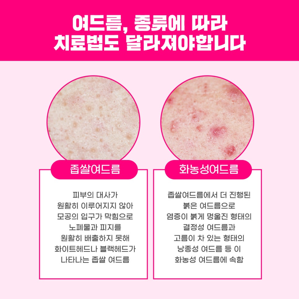 여드름과 흉터 개선에 도움을 주는 치료 방법 관련 이미지 6