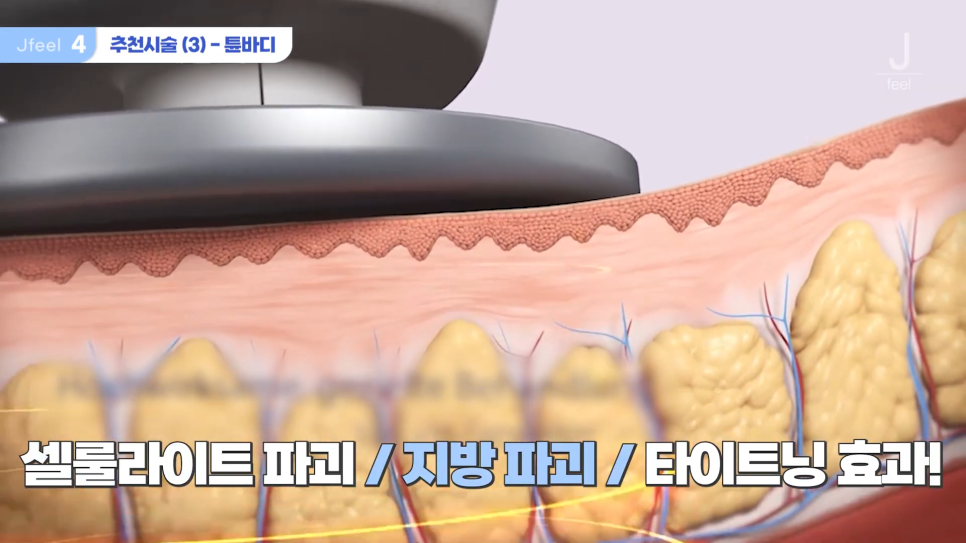 '팬츠리스룩'을 위한 셀룰라이트제거 시술 관련 이미지 11