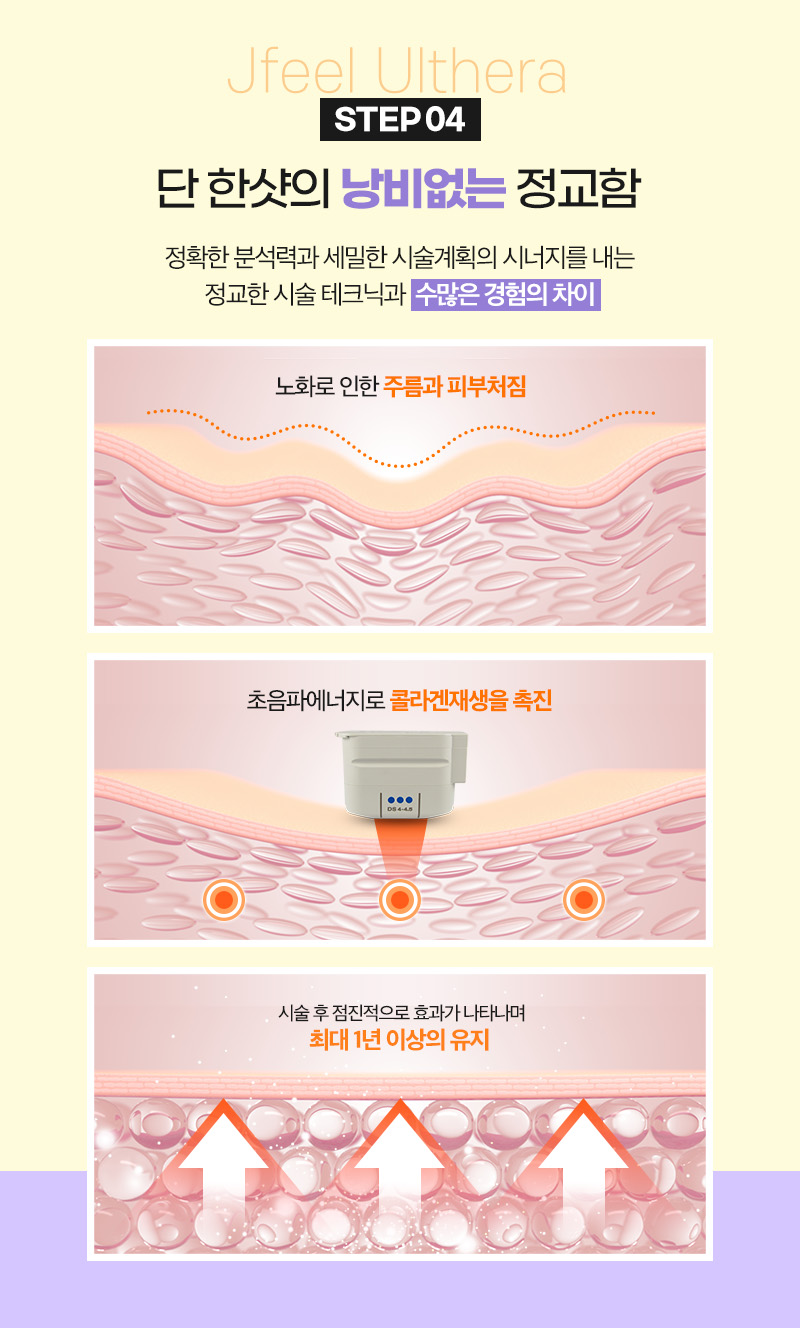 수면울쎄라로 통증 없이 얼굴 탄력 높이기 관련 이미지 6