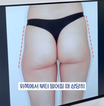 힙필러 전 꼭 알아야 할 사실|힙딥은 단순히 볼륨보다 구조가 중요합니다 관련 이미지 6