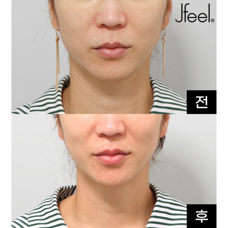가성비써마지 올리지오리프팅 효과는? 관련 이미지 1