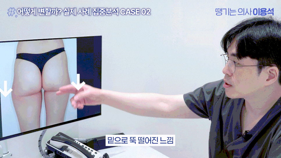 골반필러 흘러내릴까요? 유지기간부터 부작용, 힙딥까지 자주 묻는 질문 총정리 관련 이미지 10