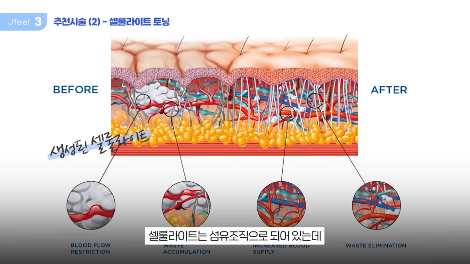 '팬츠리스룩'을 위한 셀룰라이트제거 시술 관련 이미지 8