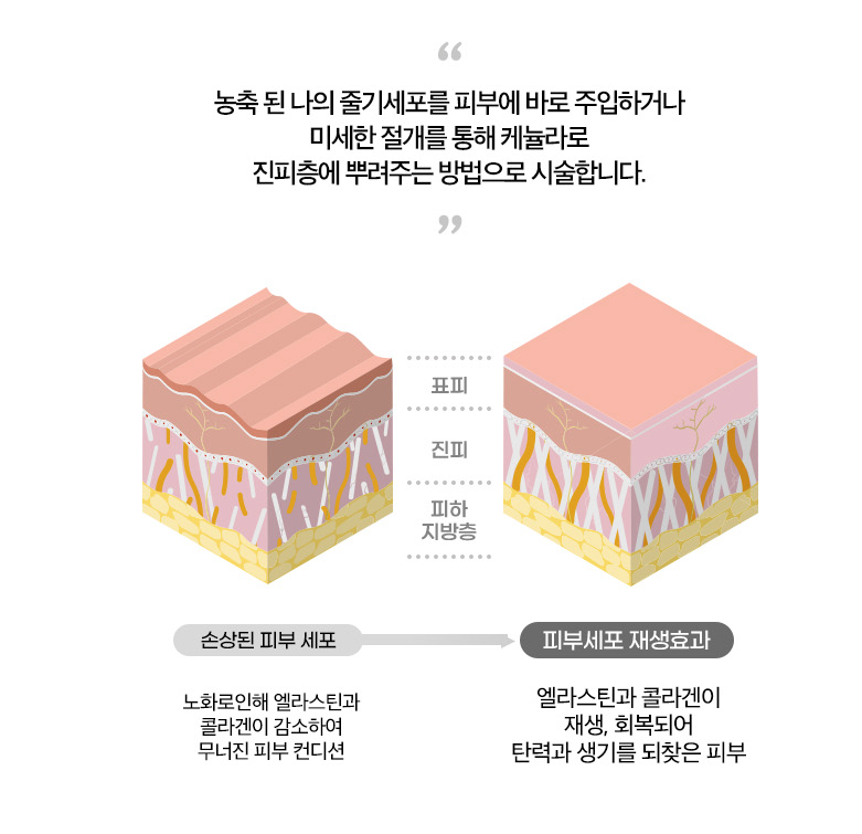 30대 40대 피부관리 추천|고우리·써마지·줄기세포 시술 TOP3 관련 이미지 13