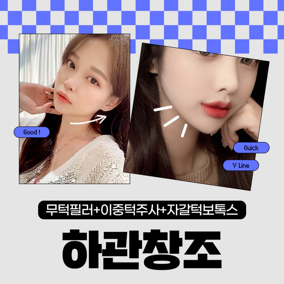 턱주사, 무턱 이중턱 자갈턱 모두 가능 관련 이미지 1