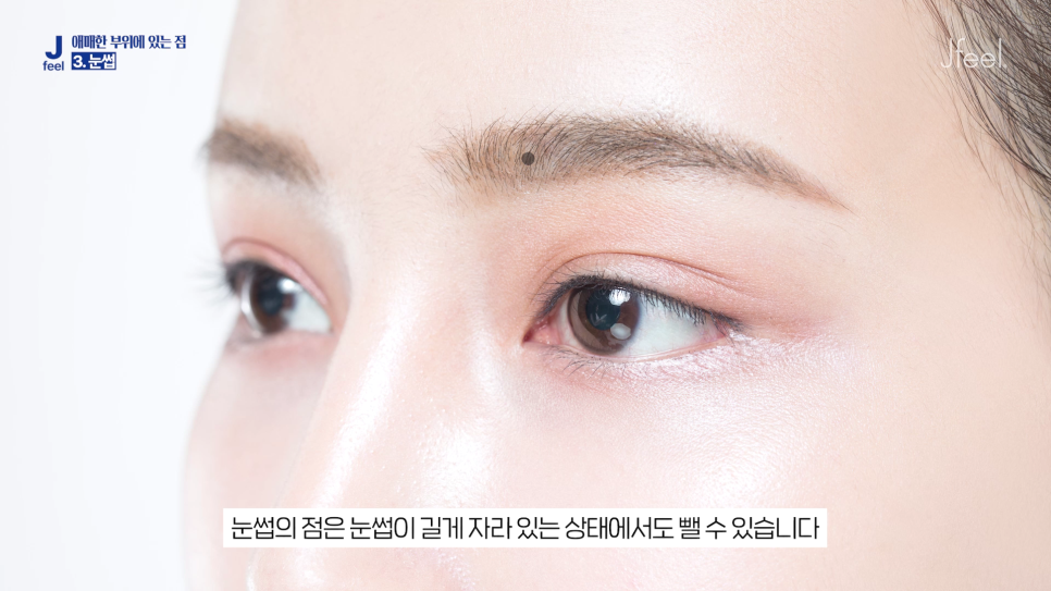 Hongdae Mole Removal: Can Moles Under the Eyes, Beside the Eyes, and on the Lips Also Be Removed? Aftercare Following Mole Removal image 10
