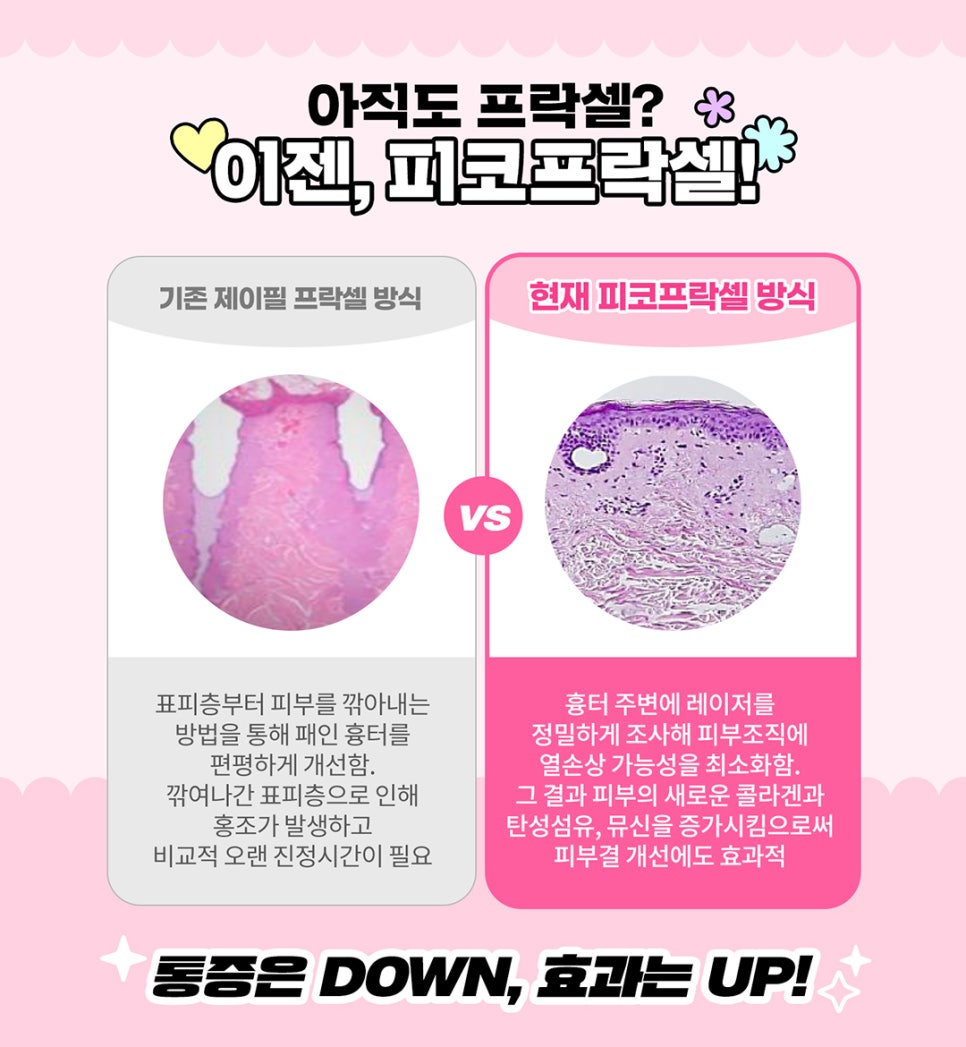 코 모공 레이저로 쫀쫀하게 모공관리! 모공케어까지 관련 이미지 4