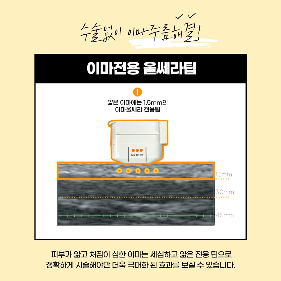 이마 거상 리프팅? 비수술 울쎄라로 이마 주름 지우자!! 관련 이미지 5