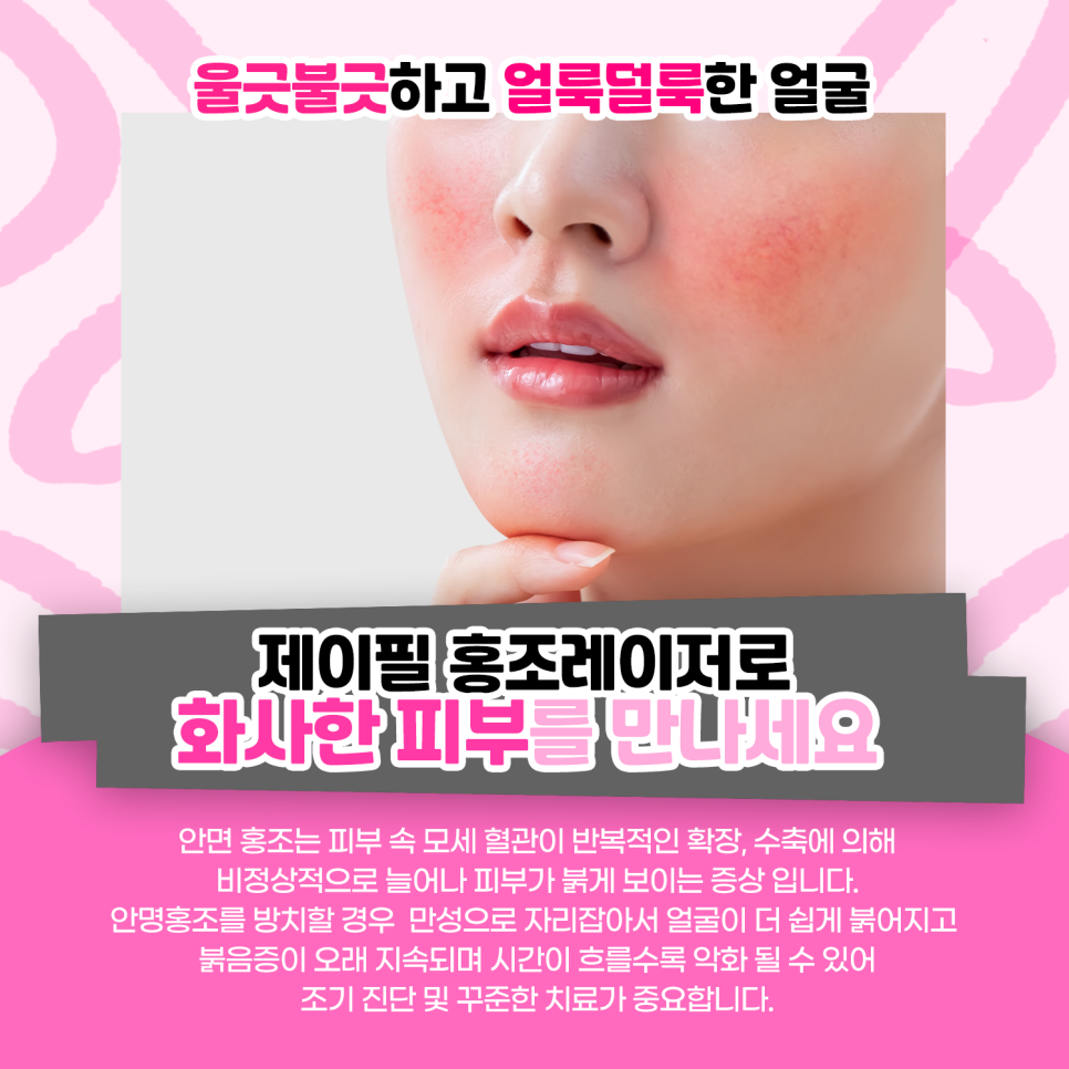 촌티나는 붉은 얼굴, 홍조레이저로 말끔하게! 관련 이미지 3