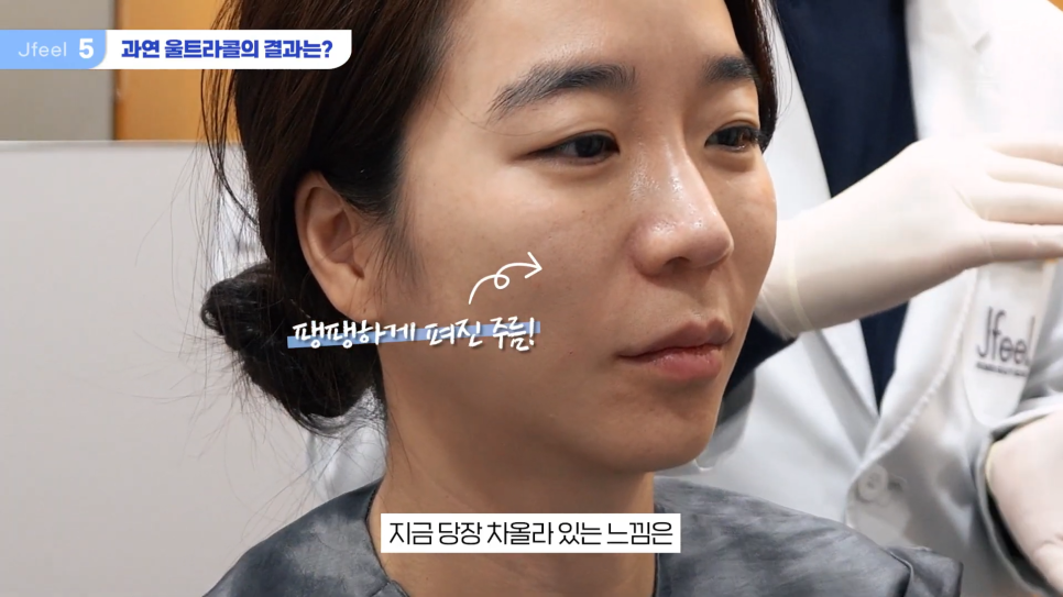 필러가 싫다면? 눈가, 팔자, 주름 해결하는 울트라콜 관련 이미지 12
