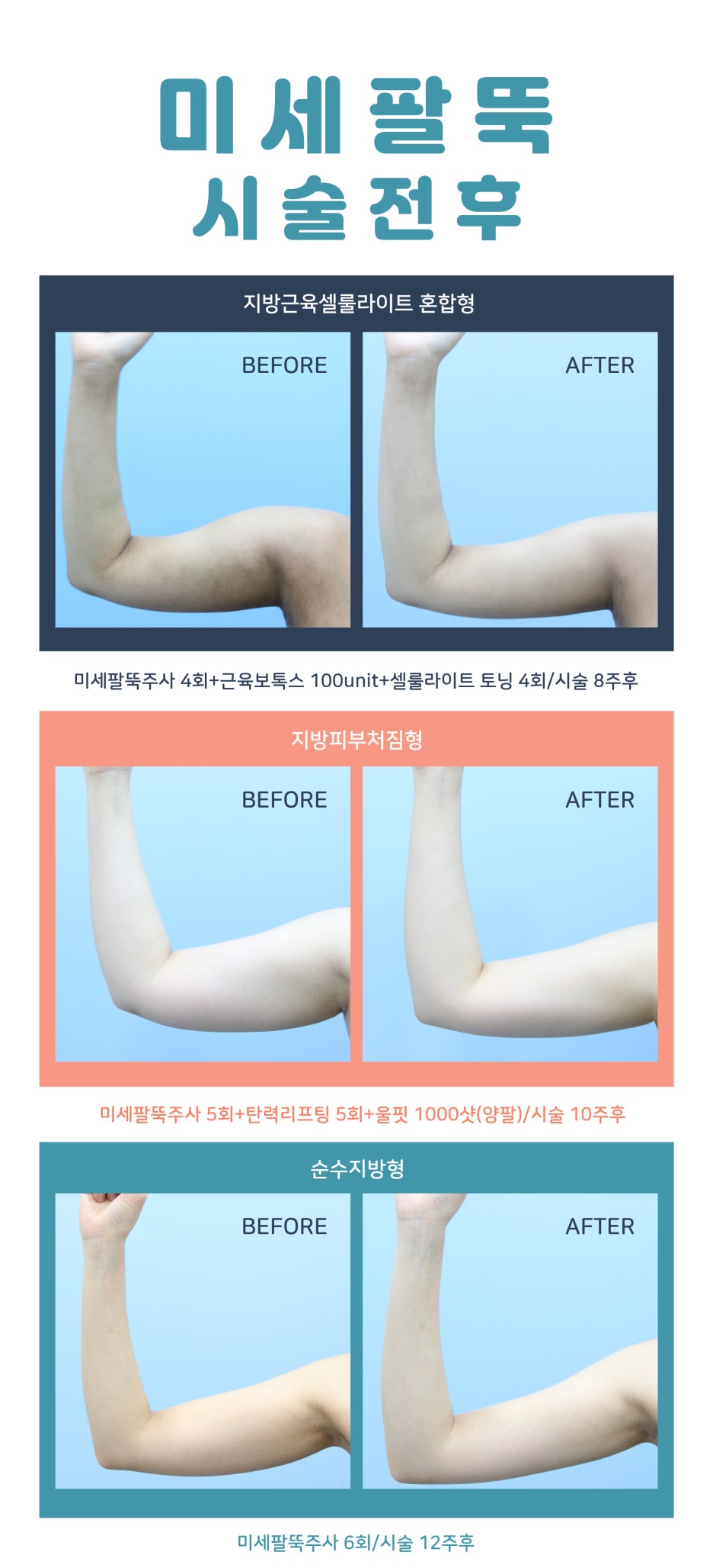 팔뚝살빼는법,쉽고 간단하게 제이필에서 관련 이미지 5