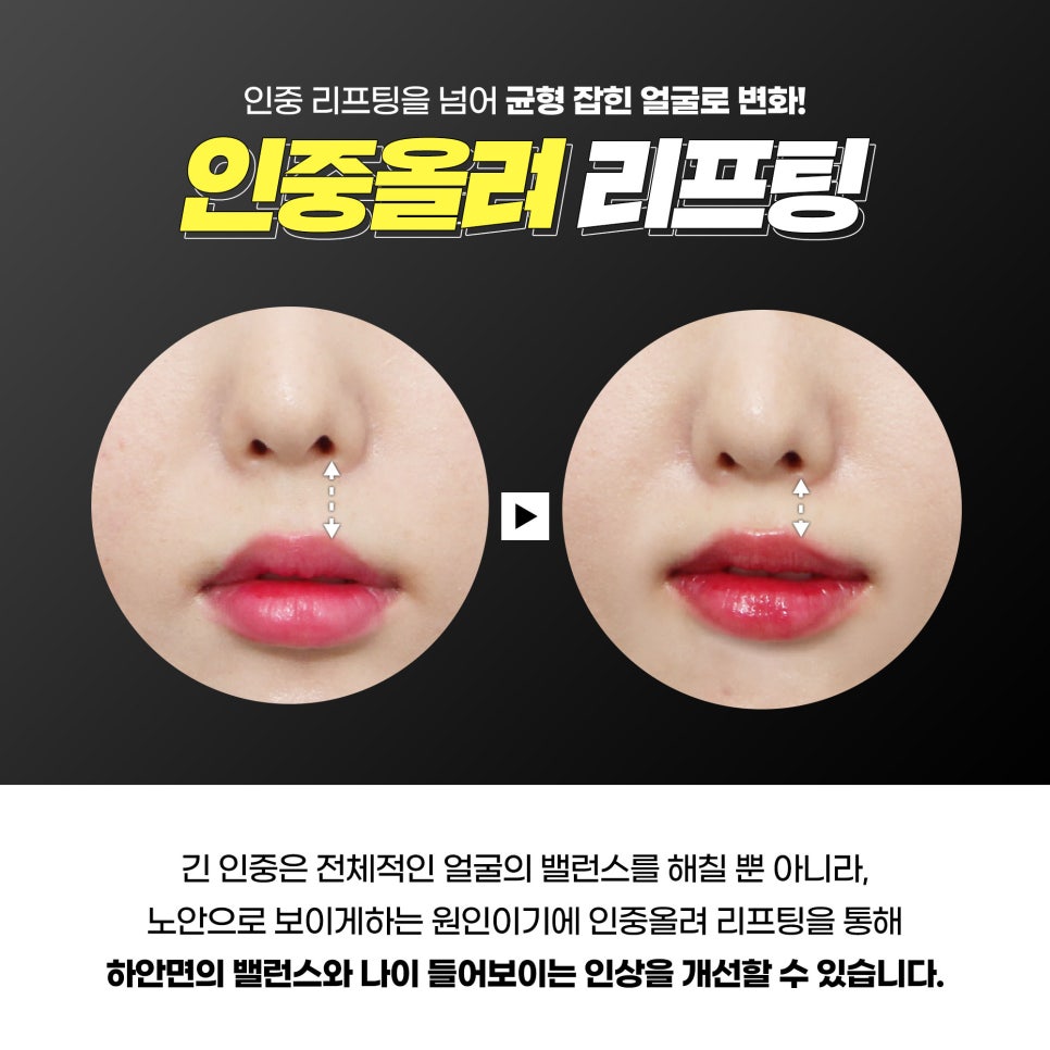 인중축소리프팅 인중축소 탄력올리는 제이필인중올려리프팅 관련 이미지 3