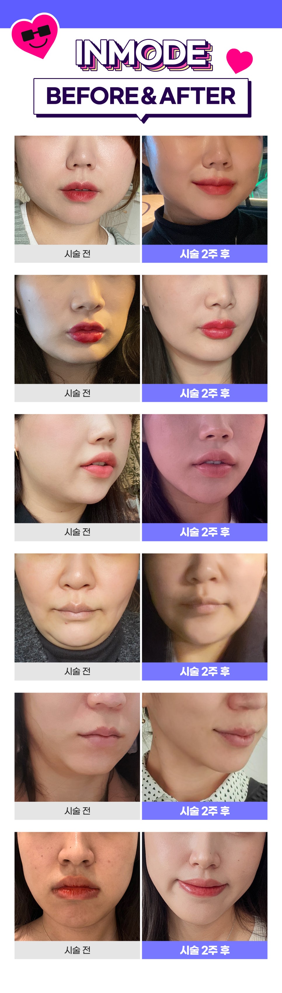 인모드리프팅 FX , FORMA 고민별로 골라받는 효과! 관련 이미지 6