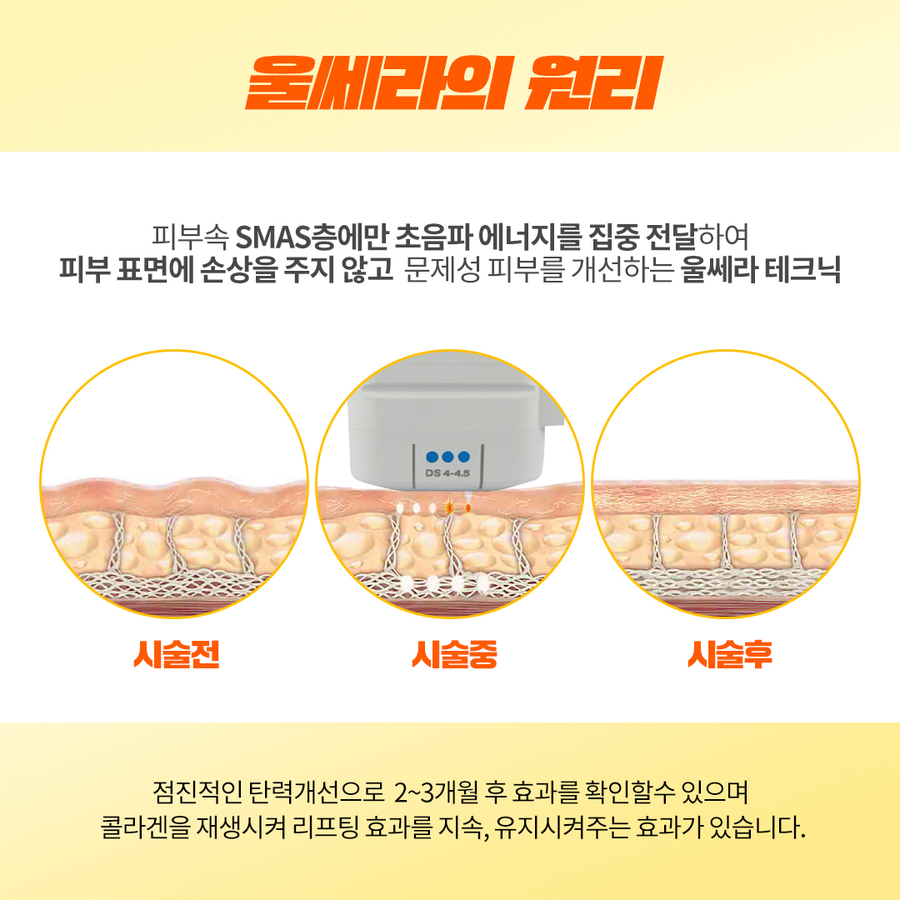 인모드,울쎄라를 이용한 리프팅 시술시 효과와 주의사항 관련 이미지 11