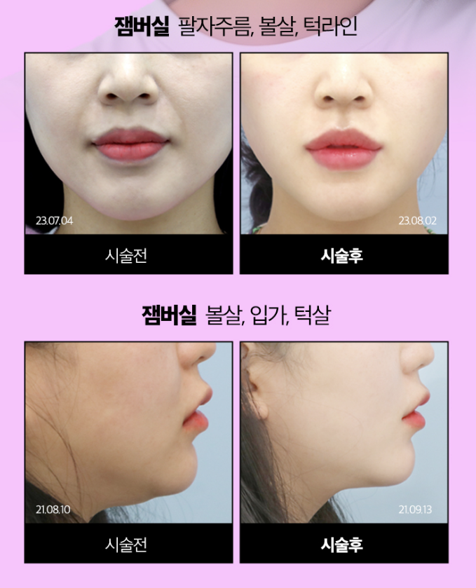 실리프팅 전문병원 선택 기준 총정리 ㅣ 실 종류&middot;디자인&middot;노하우&middot;의료진 경험 관련 이미지 7