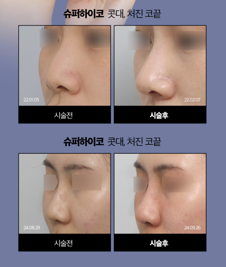 실리프팅 전문병원 선택 기준 총정리 ㅣ 실 종류&middot;디자인&middot;노하우&middot;의료진 경험 관련 이미지 17