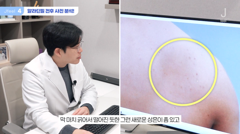 등여드름필링으로 연예인 등 만들기 관련 이미지 15