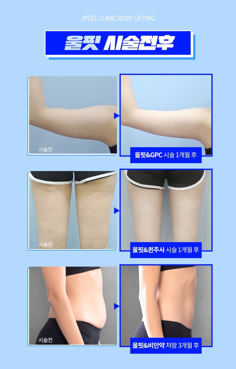 바디 슈링크, 울핏 리프팅효과 궁금하시다구요? 관련 이미지 7