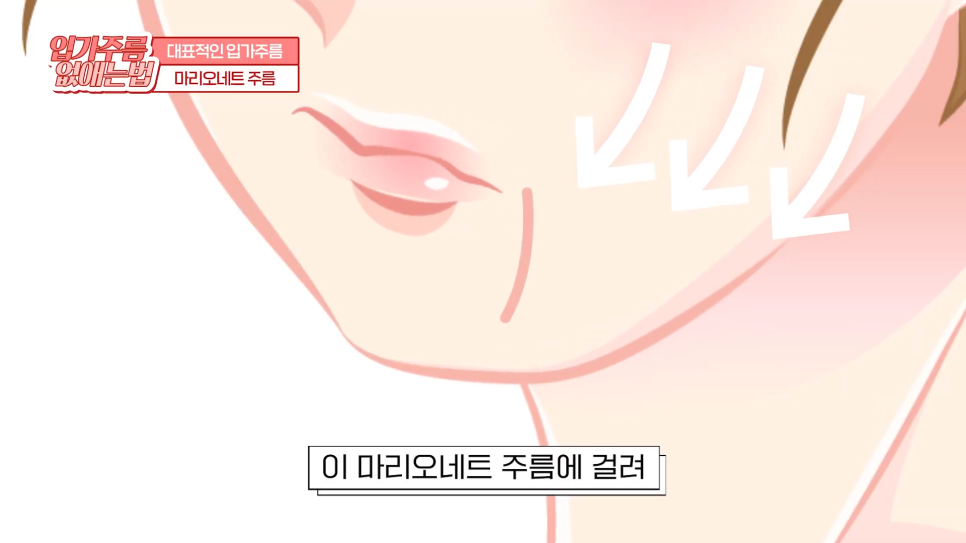 입가주름시술, 원인부터 치료, 예방까지 한 번에 관련 이미지 8