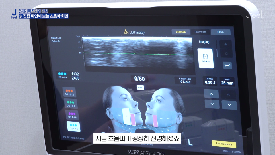 강남 울쎄라피 프라임, 울쎄라 300샷이면 누구에게나 효과가 좋을가요? 관련 이미지 5