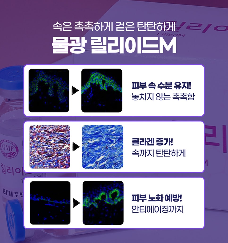 쥬베룩토닝, 토닝레이저+릴리이드+쥬베룩 효과 관련 이미지 8