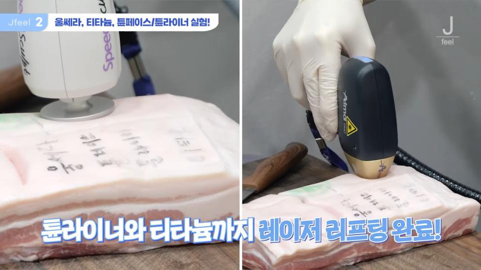 지방레이저가 얼굴 지방을 얼마나 녹일 수 있을까? 관련 이미지 5