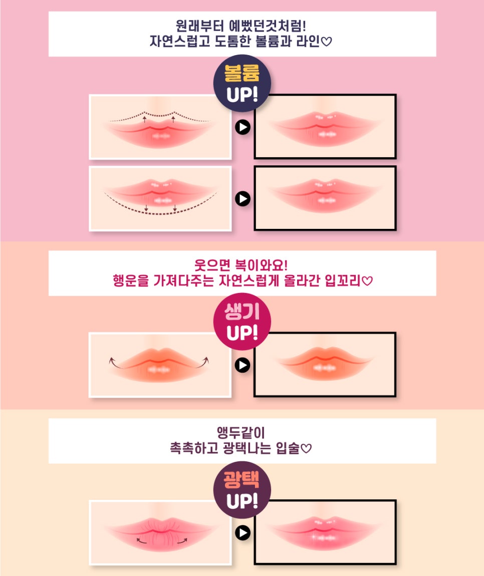 홍대필러 제이필의원 입술필러로 매력있는 립라인! 관련 이미지 3
