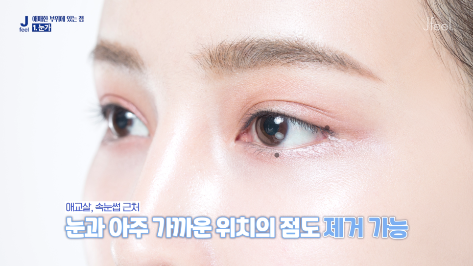 Hongdae Mole Removal: Can Moles Under the Eyes, Beside the Eyes, and on the Lips Also Be Removed? Aftercare Following Mole Removal image 5