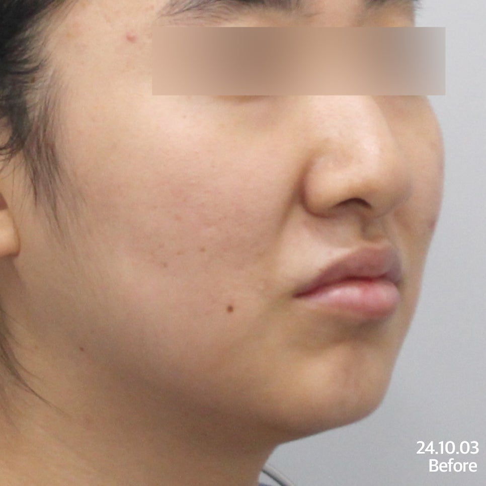 튠라이너 & 튠페이스 시술, 어떤 효과 있을까? 리프팅 + 탄력 관련 이미지 7