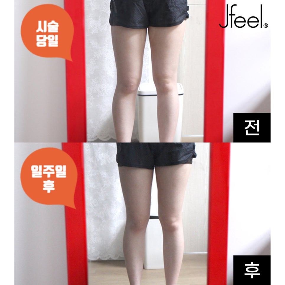 허벅지살빼는법 어렵지 않아요 허벅지지방분해주사 퀸 관련 이미지 2