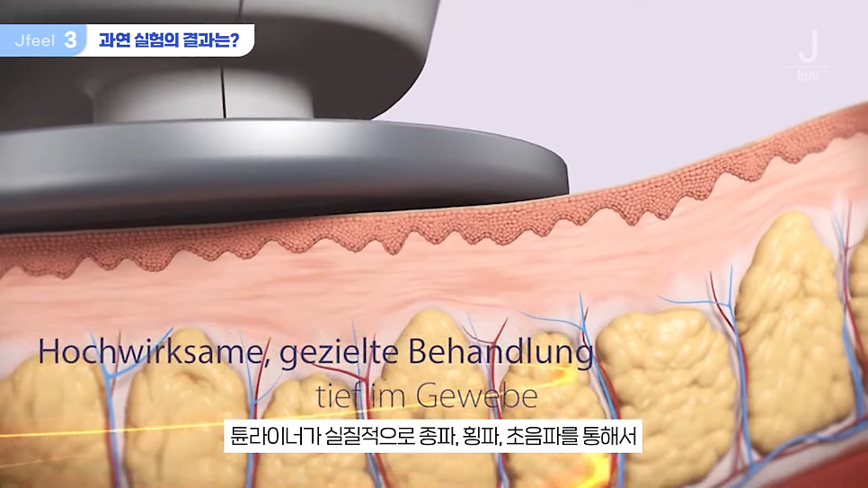 지방레이저가 얼굴 지방을 얼마나 녹일 수 있을까? 관련 이미지 10