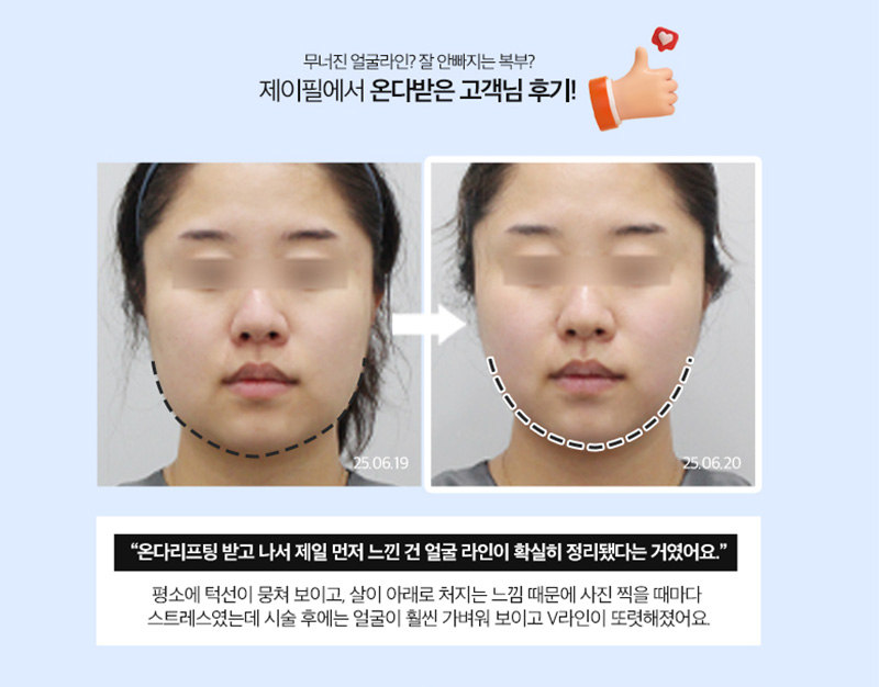 Ligament Filler + ONDA | Why Mid-Cheek and Jawline Lifting Matter image 8