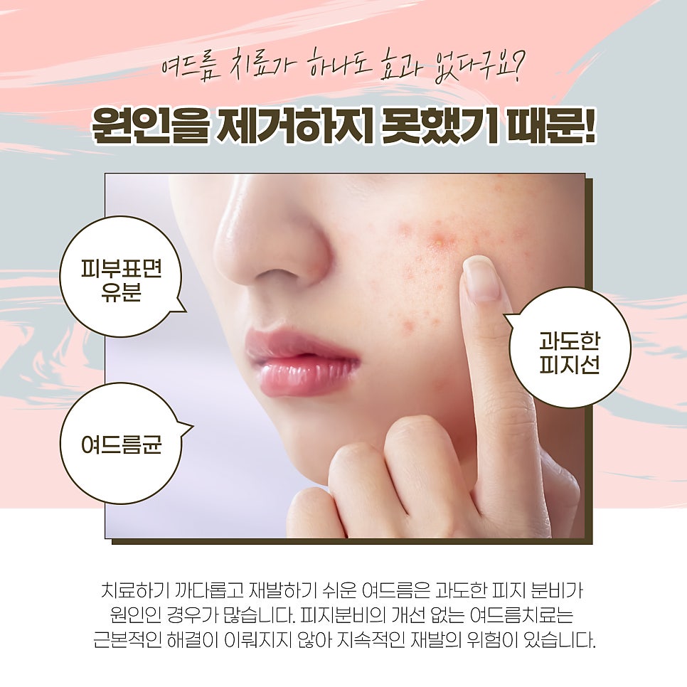 피지분비, 피지억제레이저로 여드름 끝장내기! 관련 이미지 2