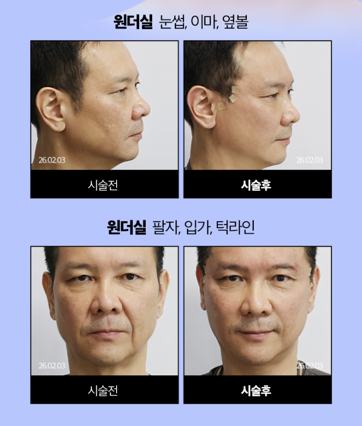 실리프팅 전문병원 선택 기준 총정리 ㅣ 실 종류&middot;디자인&middot;노하우&middot;의료진 경험 관련 이미지 9