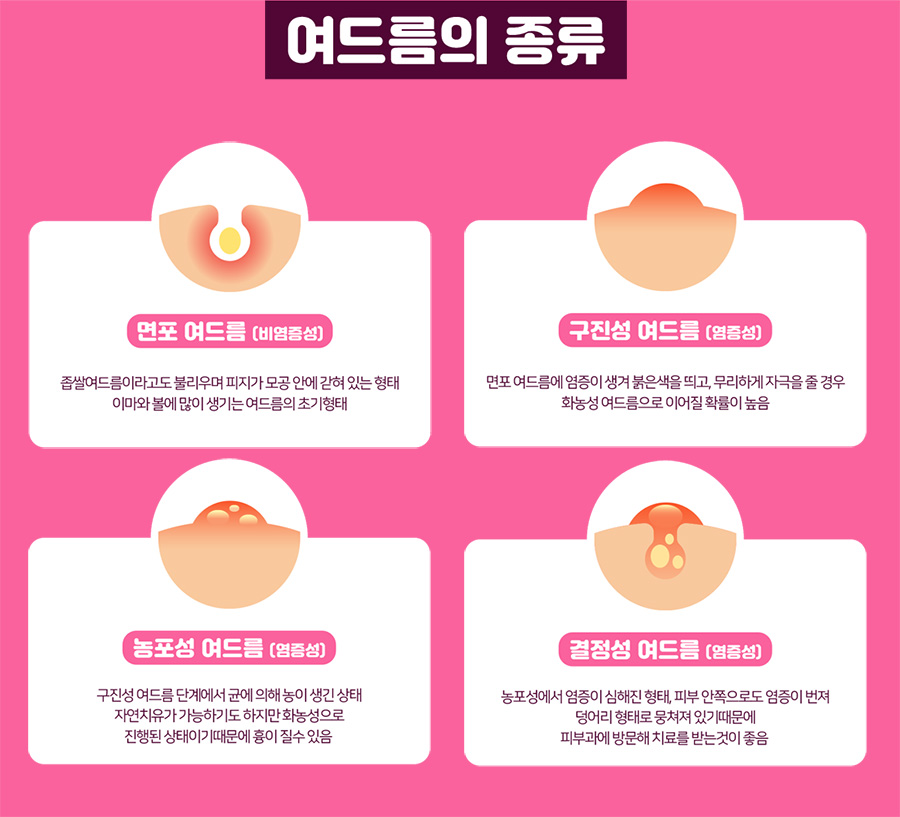 여드름과 흉터 개선에 도움을 주는 치료 방법 관련 이미지 3