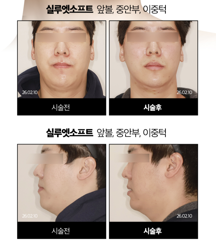 실리프팅 전문병원 선택 기준 총정리 ㅣ 실 종류&middot;디자인&middot;노하우&middot;의료진 경험 관련 이미지 4