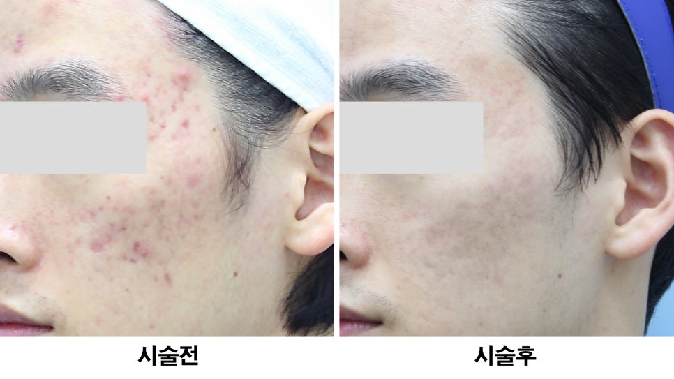 [홍대피부과] 쉿! 나만 아는 모공축소 비밀, 시크릿레이저 관련 이미지 8