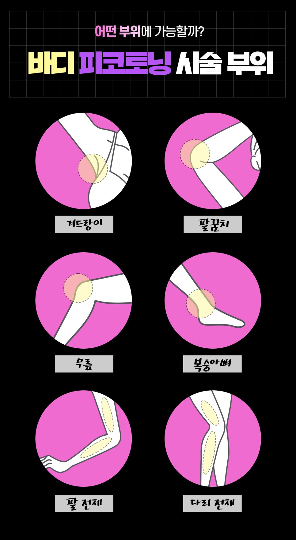 몸색소침착, 바디피코토닝으로 깨끗하게 관련 이미지 3