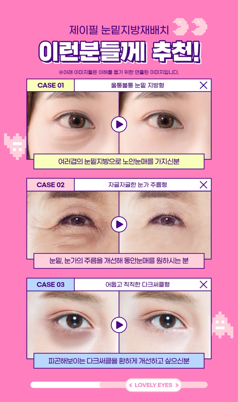 눈밑지방재배치 수술 말고 레이저로 간단하게! 관련 이미지 5