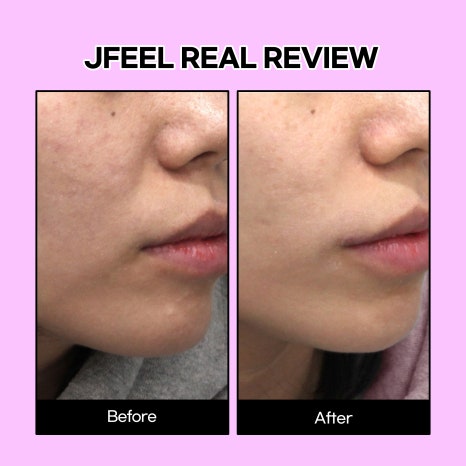 The Key to the Clean Girl Skin Routine | A Complete Guide to Rejuran, 5 Lasers, and Titanium image 7