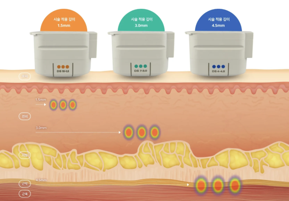 얼굴살 없으면 울쎄라 하면 안 될까? 볼패임 걱정된다면 확인할 것 관련 이미지 10