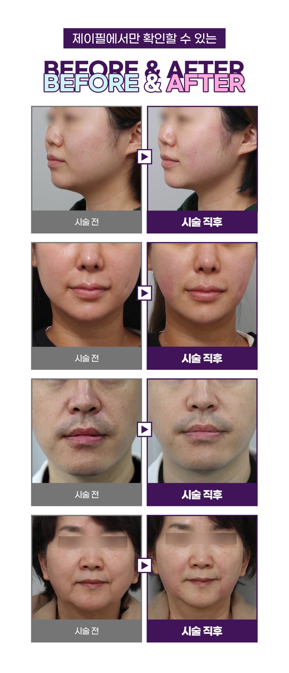 홍대리프팅, 제이필슈링크로 통증 없이 원하는 대로! 관련 이미지 10