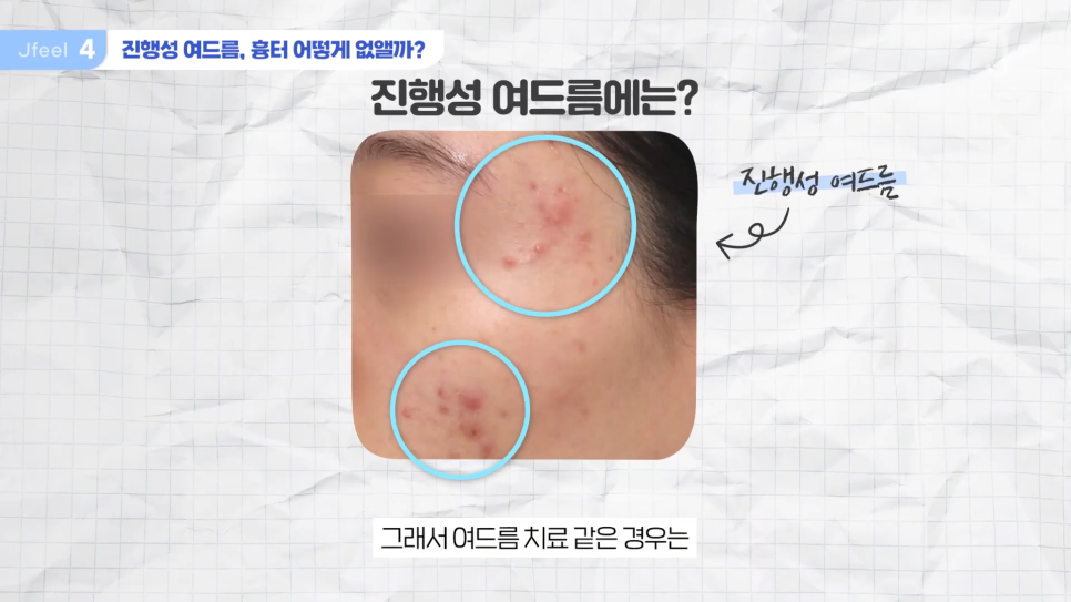 수능 후 피부과시술 추천, 고3& 사회 초년생 필독 관련 이미지 16