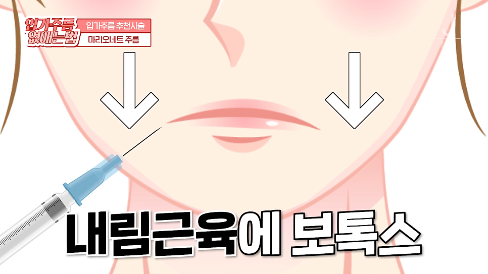입가주름시술, 원인부터 치료, 예방까지 한 번에 관련 이미지 12