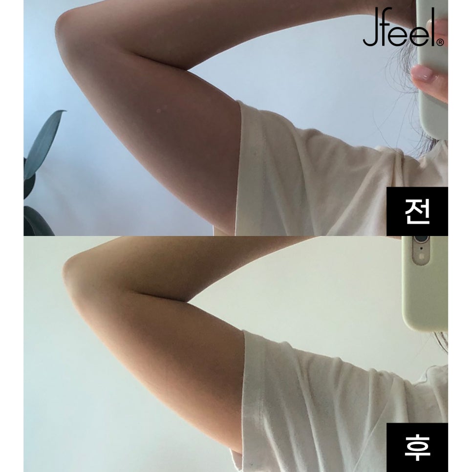 팔뚝지방분해주사 리얼 후기 (no스테로이드) 관련 이미지 2
