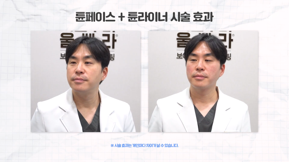 얼굴라인 30분 만에 완성, 튠페이스 튠라이너 관련 이미지 6