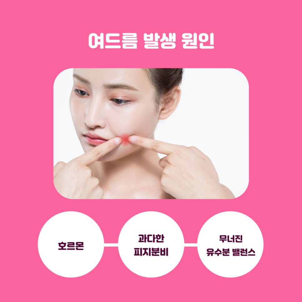 화농성여드름에도 탁월한 여드름레이저 관련 이미지 4