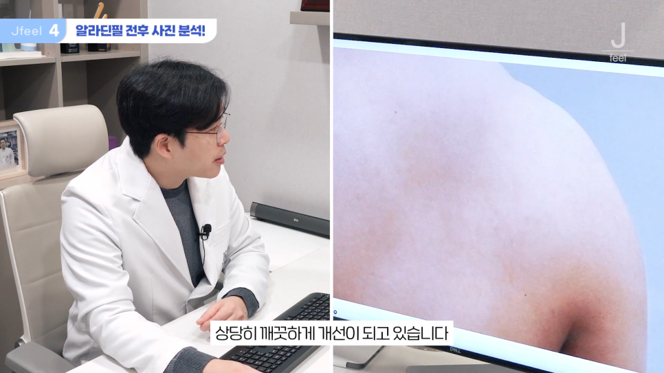 등여드름필링으로 연예인 등 만들기 관련 이미지 17