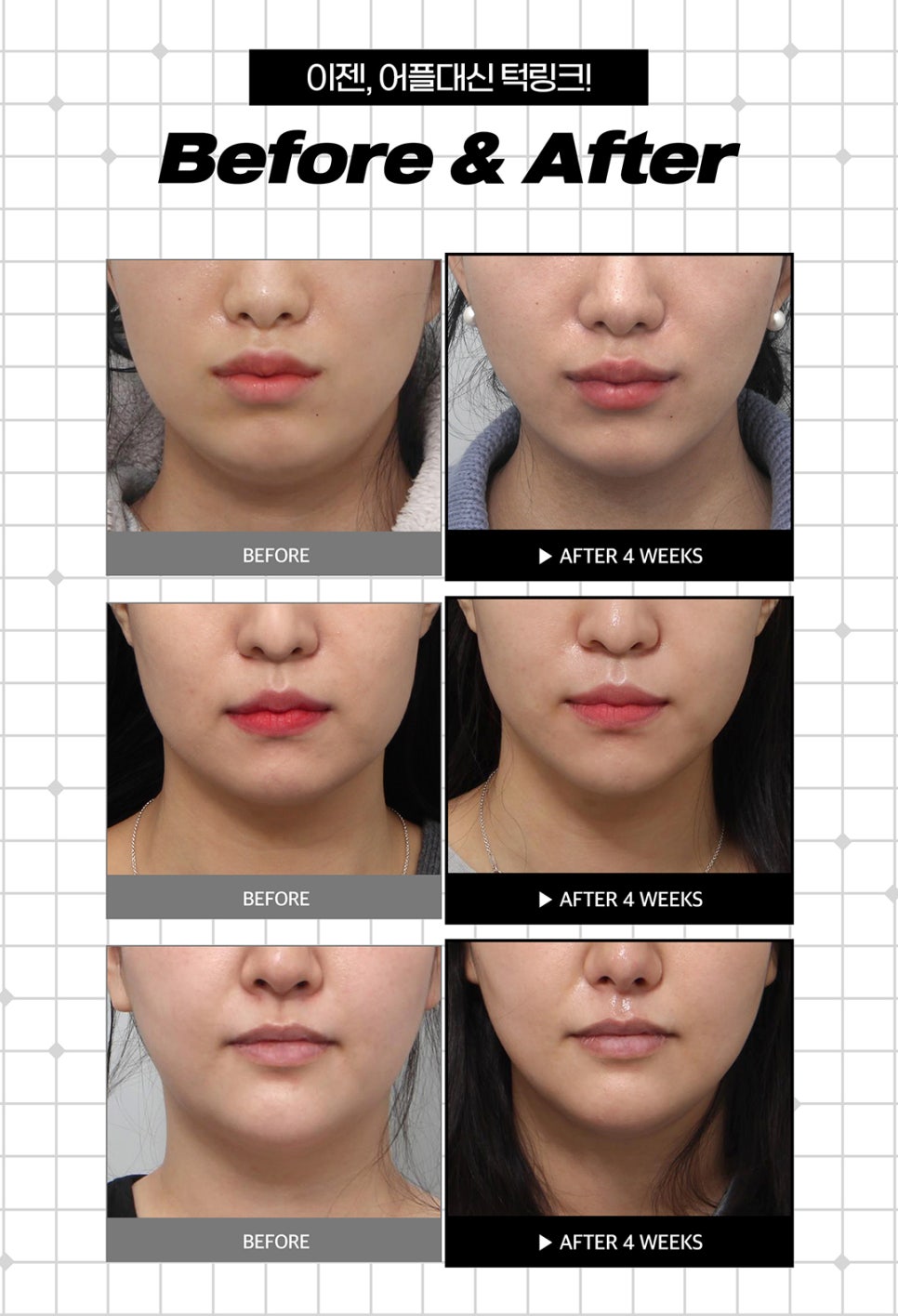 턱슈링크, 브이라인 조각 리프팅 관련 이미지 8
