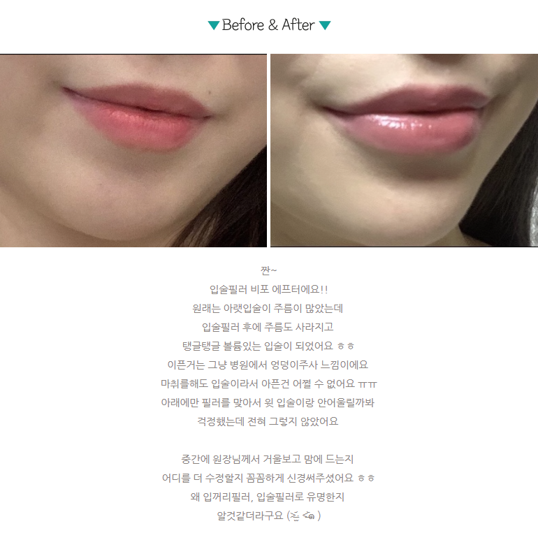 자연스러운 입술필러 후기/전후/가격 알아보세요 관련 이미지 1